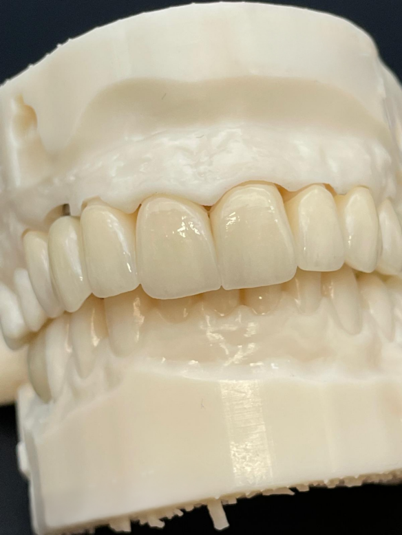 Coroană Full Contour Zirconiu