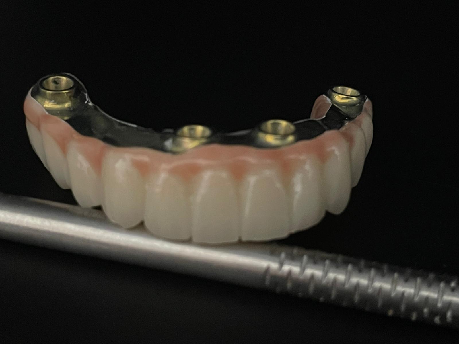 All-on-4/6 – Lucrare protetică finală Titan + Zirconiu Standard - imagine 3