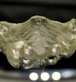 În cazurile implantare complexe, laboratorul trebuie implicat înainte ca deciziile chirurgicale să devină definitive.