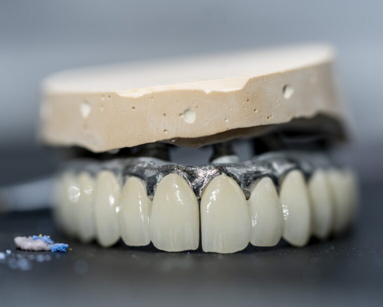 Restaurare metalo-ceramică extinsă și infrastructura sa pe model de laborator