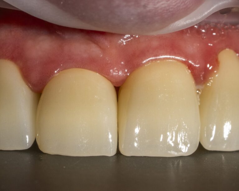 Probă clinică frontală a unei restaurări extinse pentru verificarea esteticii și adaptării