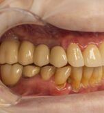 Fotografie clinică intraorală utilizată pentru comunicarea cu laboratorul dentar