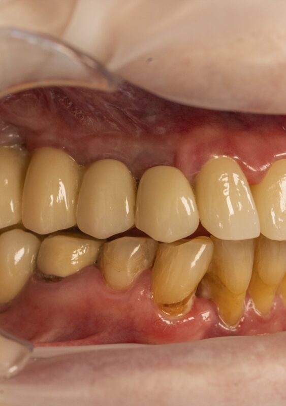 Fotografie clinică intraorală utilizată pentru comunicarea cu laboratorul dentar
