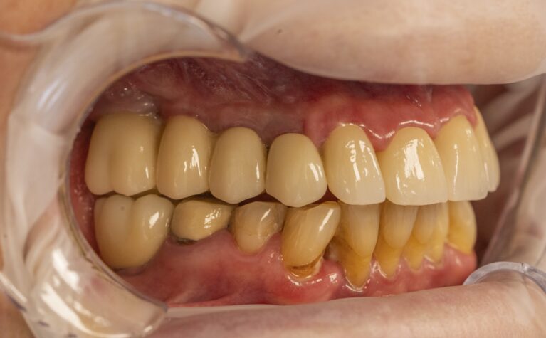 Fotografie clinică intraorală utilizată pentru comunicarea cu laboratorul dentar