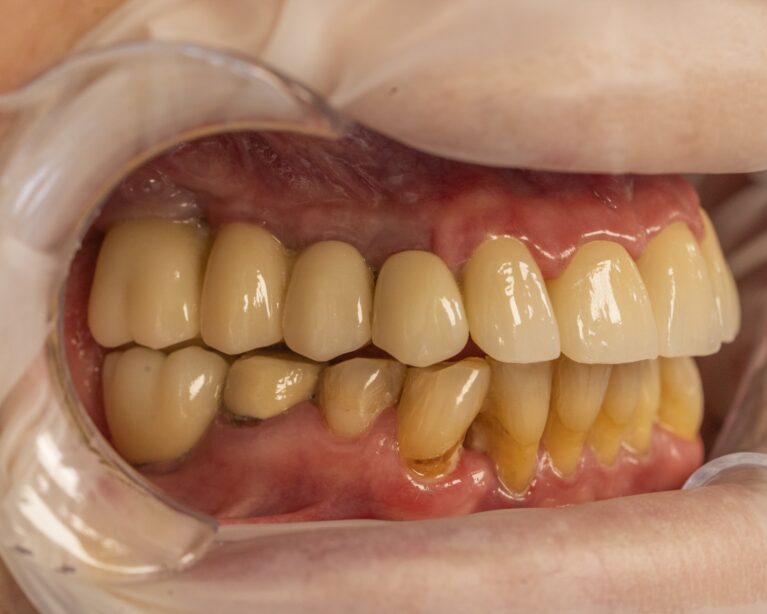 Fotografie clinică intraorală utilizată pentru comunicarea cu laboratorul dentar