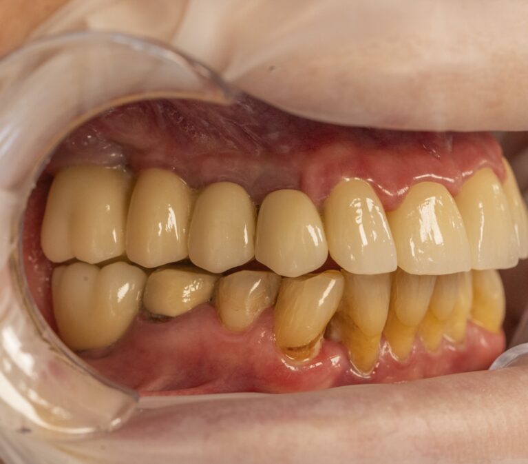 Fotografie clinică intraorală utilizată pentru comunicarea cu laboratorul dentar