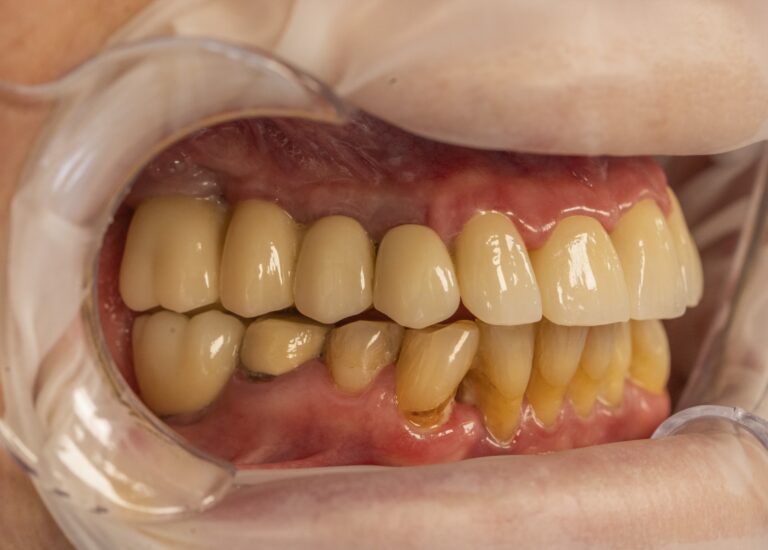 Fotografie clinică intraorală utilizată pentru comunicarea cu laboratorul dentar