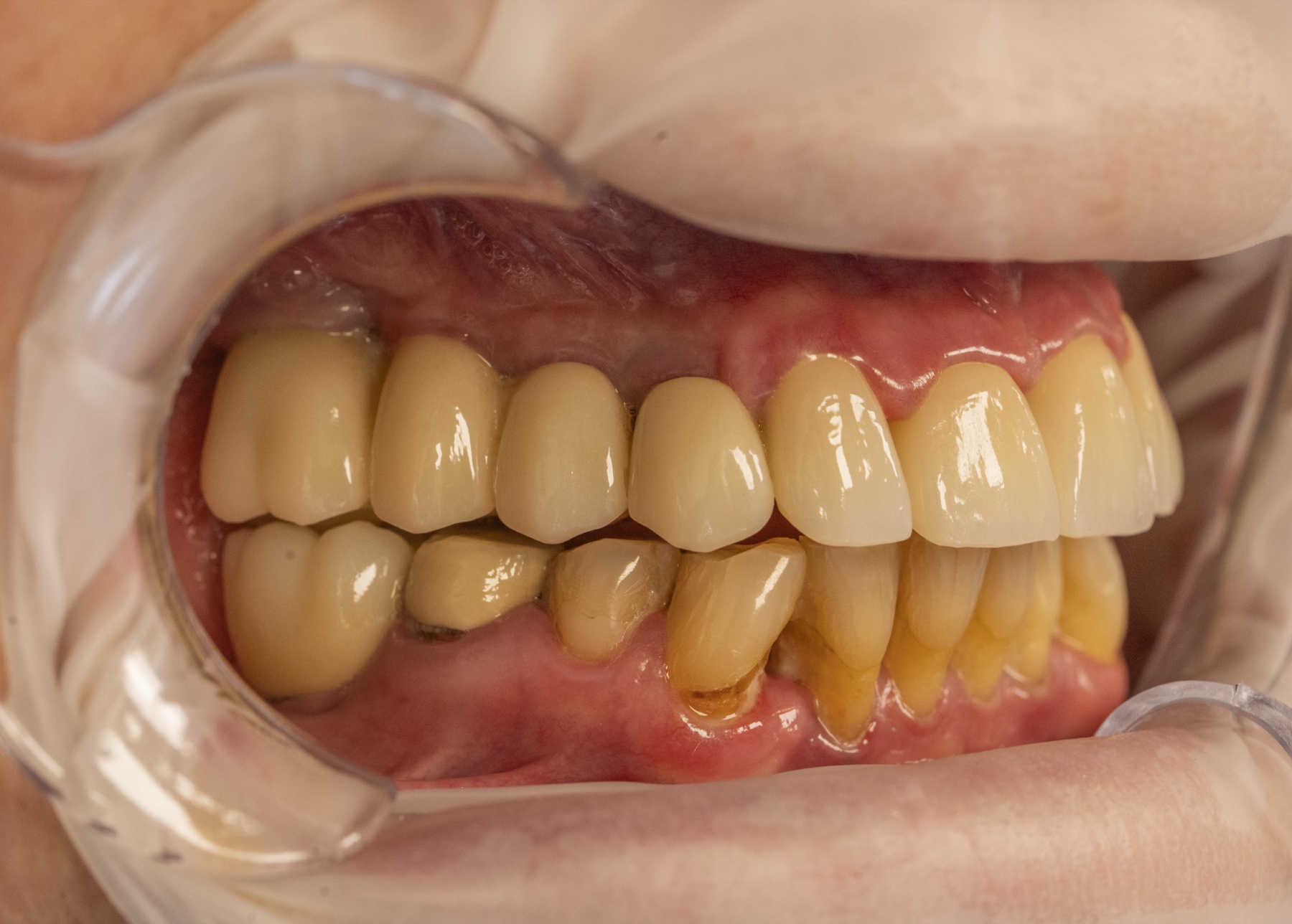 Fotografie clinică intraorală utilizată pentru comunicarea cu laboratorul dentar